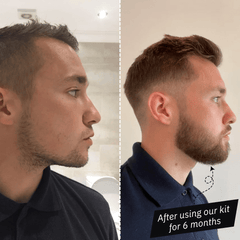 Customer transformation using our Beard Growth Kit